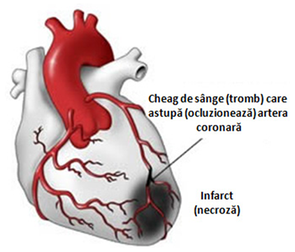 infarct miocardic durere localizată în articulația șoldului
